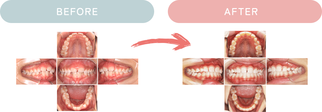 before after