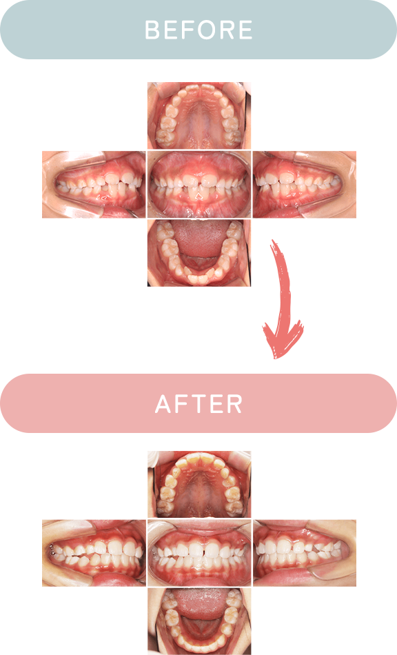before after